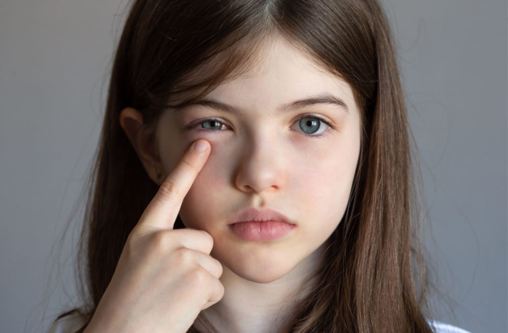 A young girl is pointing to her eye that got infected by rubbing it.