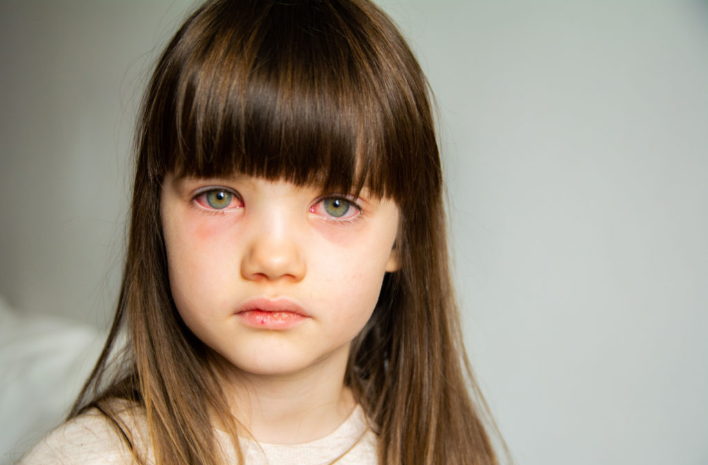 A young girl with red, swollen eyes from pink eye.