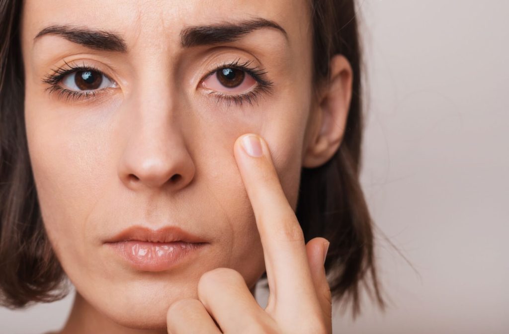 A patient with a red, irritated eye.