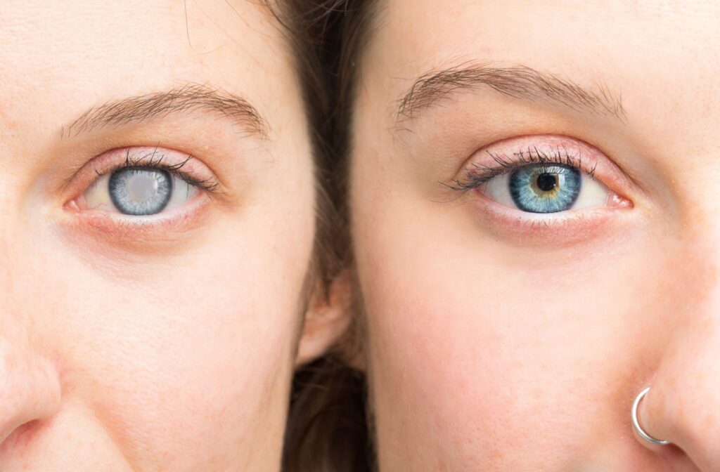 Close-up of two people's eyes, one clouded over with grey cataract and the other a clear blue.
