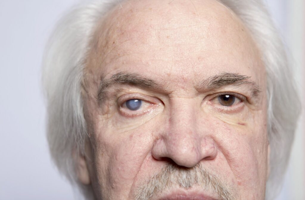 Close-up of an older adult's eyes with the right eye being in the mature stage of cataract development.