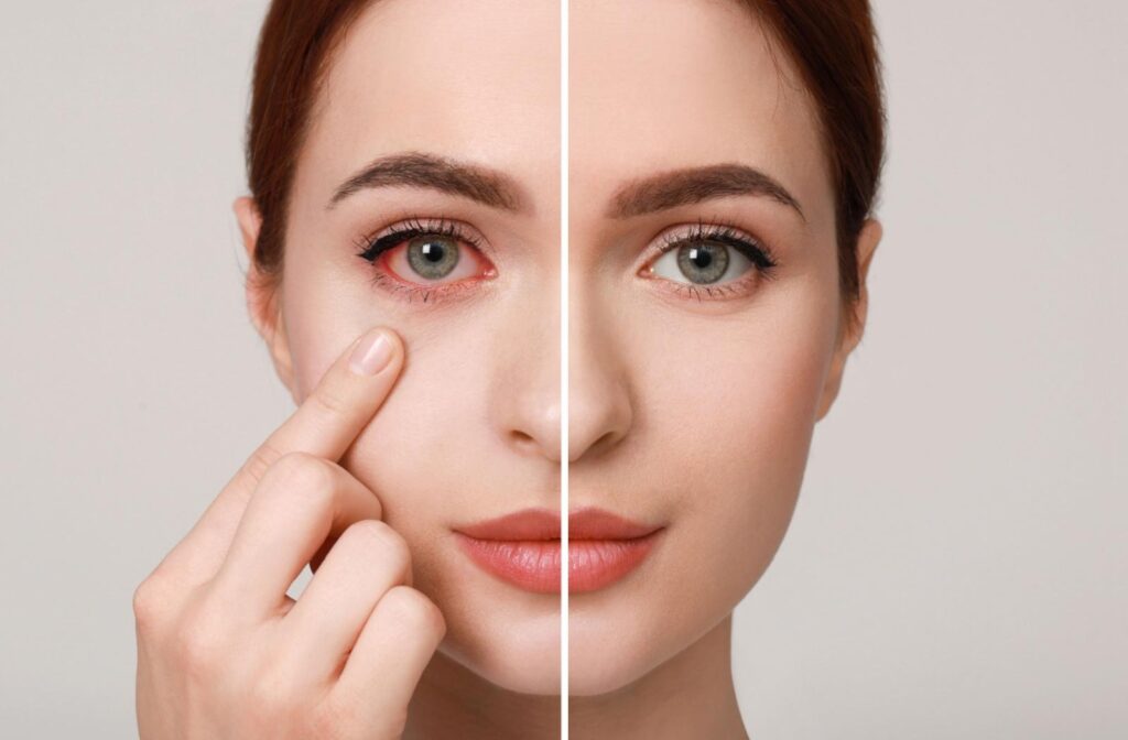 A side by side comparison of an eye that has pink eye and an eye that doesn't.